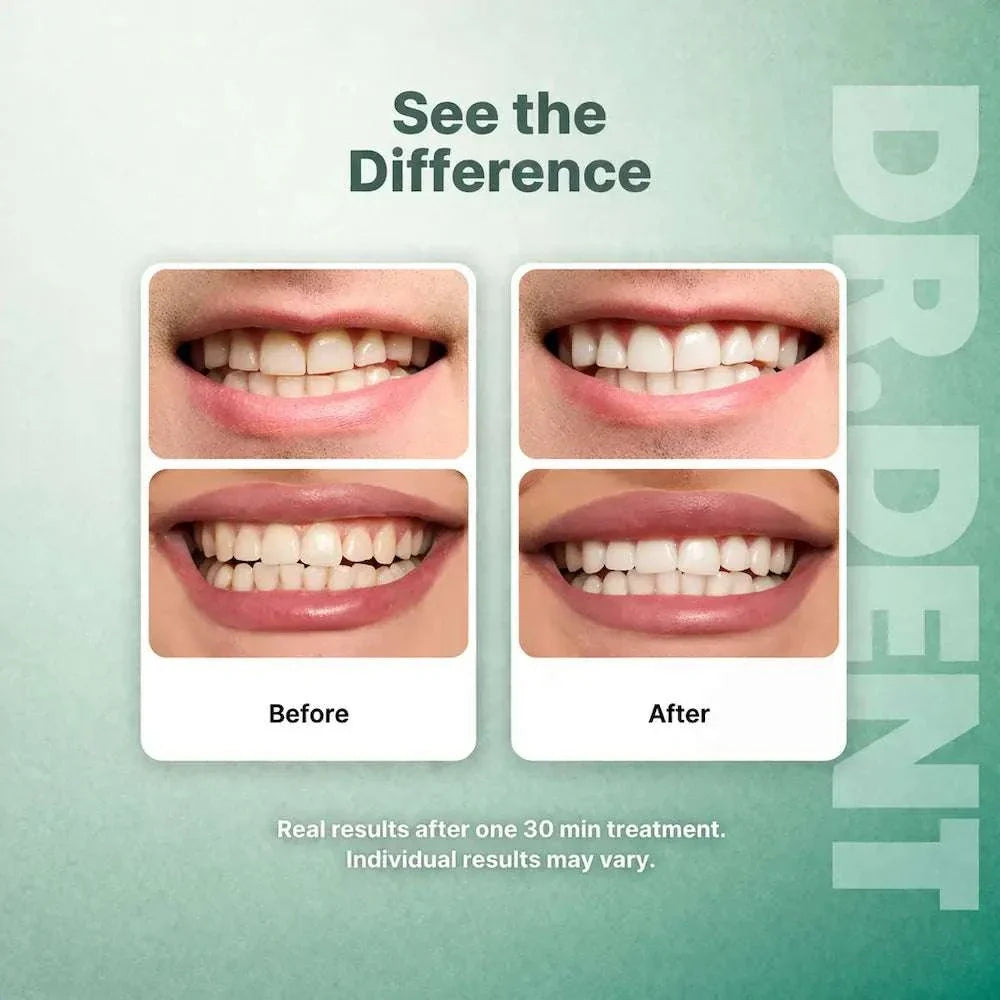 Purple teeth whitening strips for brightening smile